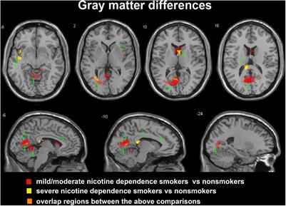 Brain Structure Alterations in Respect to Tobacco Consumption and Nicotine Dependence: A Comparative Voxel-Based Morphometry Study